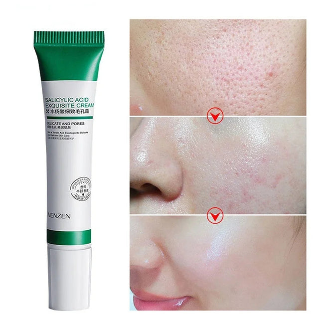 Creme Para Remoção De Poros E Clareamento de Manchas Kaypestore