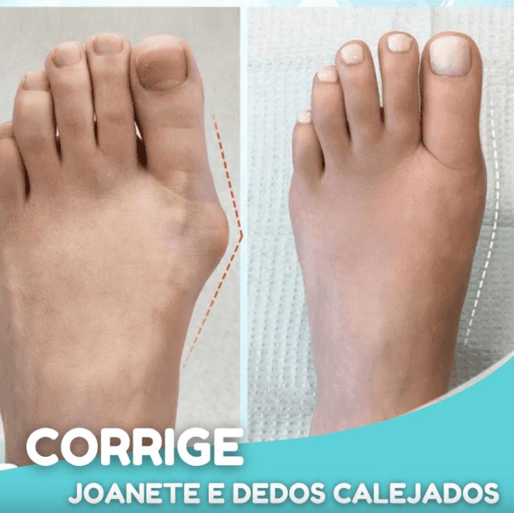 JoanettOriginal - Corretor Ortopédico de Joanetes e Pé Chato (2 Peças) ORT008 Kaypestore 